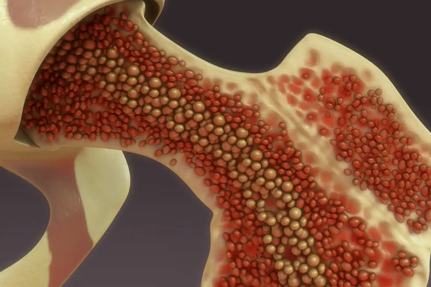 greyledge-platelet-poor-plasma-thumbnail_3 A 3D anatomical illustration of bone marrow inside a human femur with red and yellow cells.
