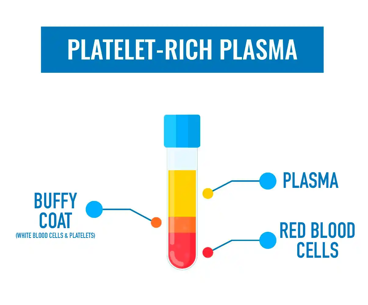 A diagram of blood components in a test tube showing plasma, buffy coat, and red blood cells for PRP